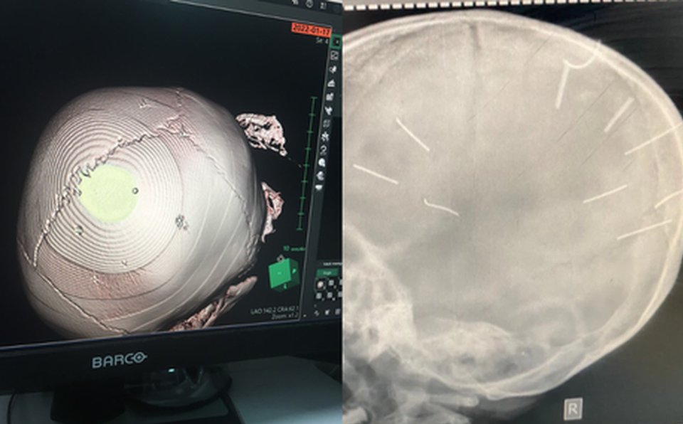 H&igrave;nh ảnh chụp X-quang hộp sọ b&eacute; 3 tuổi ở H&agrave; Nội cho thấy c&oacute; nhiều vật thể nghi l&agrave; đinh trong đầu (Ảnh: BVCC).
