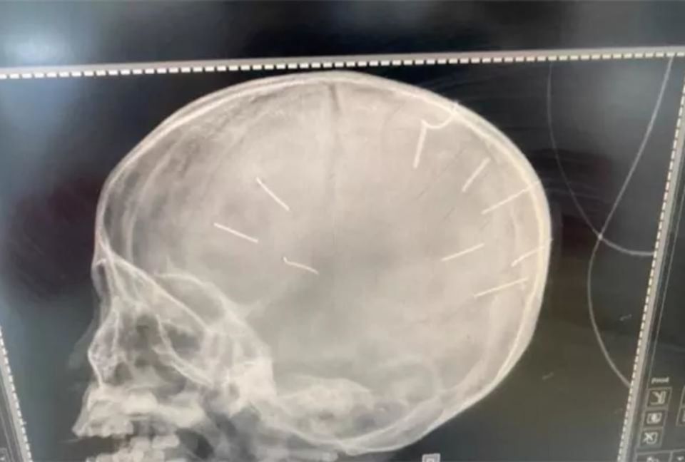Ảnh chụp X-quang hộp sọ b&eacute; Đ.N.A. 3 tuổi ở huyện Thạch Thất, H&agrave; Nội cho thấy c&oacute; 9 vật thể nghi l&agrave; đinh găm trong đầu.