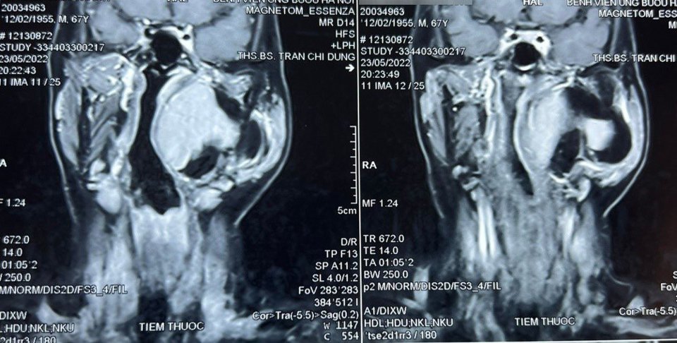 H&igrave;nh ảnh chụp cộng hưởng từ khối u khoảng b&ecirc;n họng của bệnh nh&acirc;n