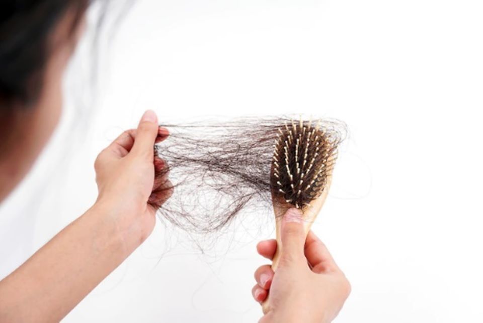 Rụng tóc hình đồng xu bị bệnh gì có nguy hiểm không  VIETSKIN