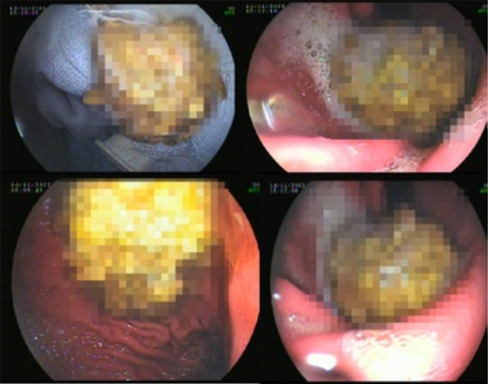 Khối b&atilde; thức ăn được lấy ra từ dạ d&agrave;y của bệnh nh&acirc;n. Ảnh BVCC
