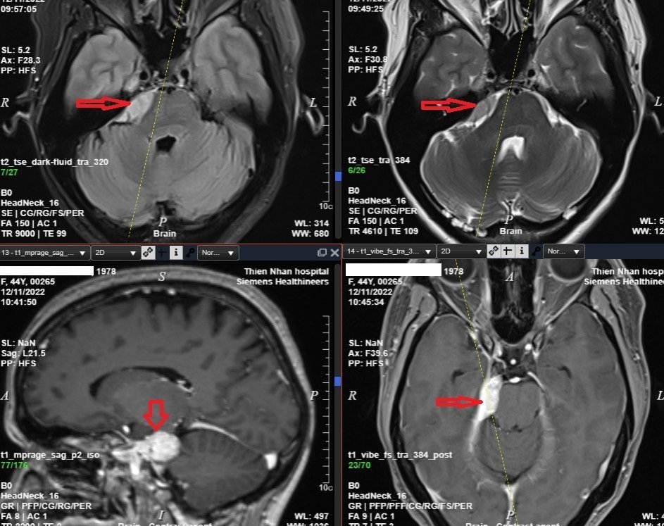 H&igrave;nh ảnh chụp MRI n&atilde;o c&oacute; ti&ecirc;m thuốc đối quang từ của chị N cho thấy r&otilde; u m&agrave;ng n&atilde;o.