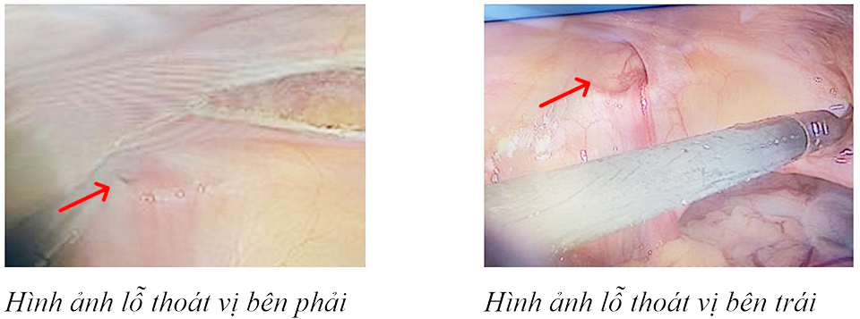 Thoát vị bẹn ở nữ: Gây biến chứng cao, liên quan đến bất thường giới tính - Ảnh 1