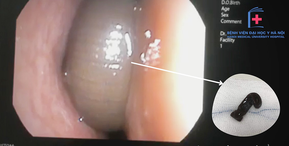 Tại Bệnh viện Đại học Y H&agrave; Nội, các b&aacute;c sĩ đ&atilde; gắp dị vật ra khỏi mũi cho bệnh nh&acirc;n an to&agrave;n.
