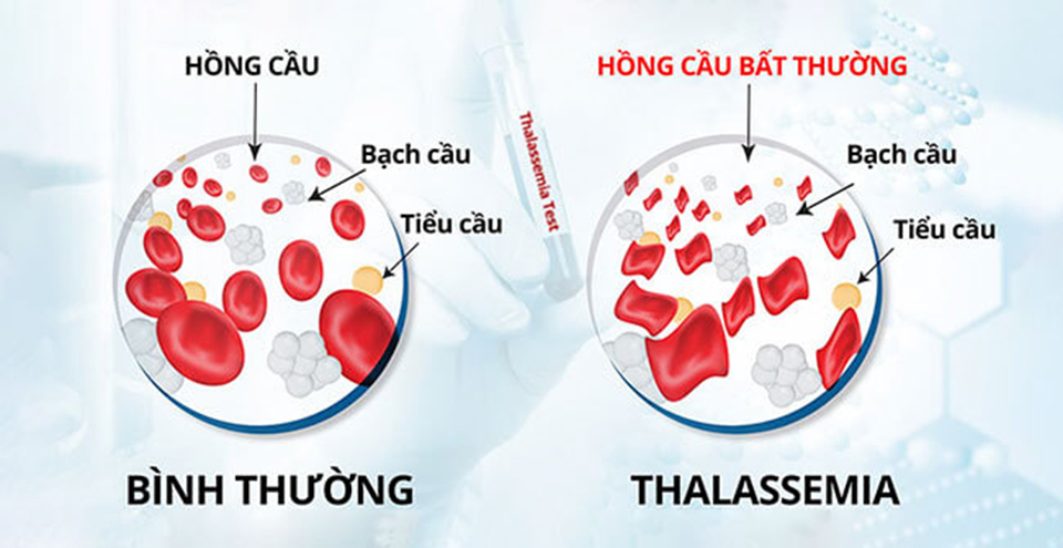 Bệnh nh&acirc;n Thalassemia, do hồng cầu vỡ sớm hơn b&igrave;nh thường dẫn đến t&igrave;nh trạng thiếu m&aacute;u.