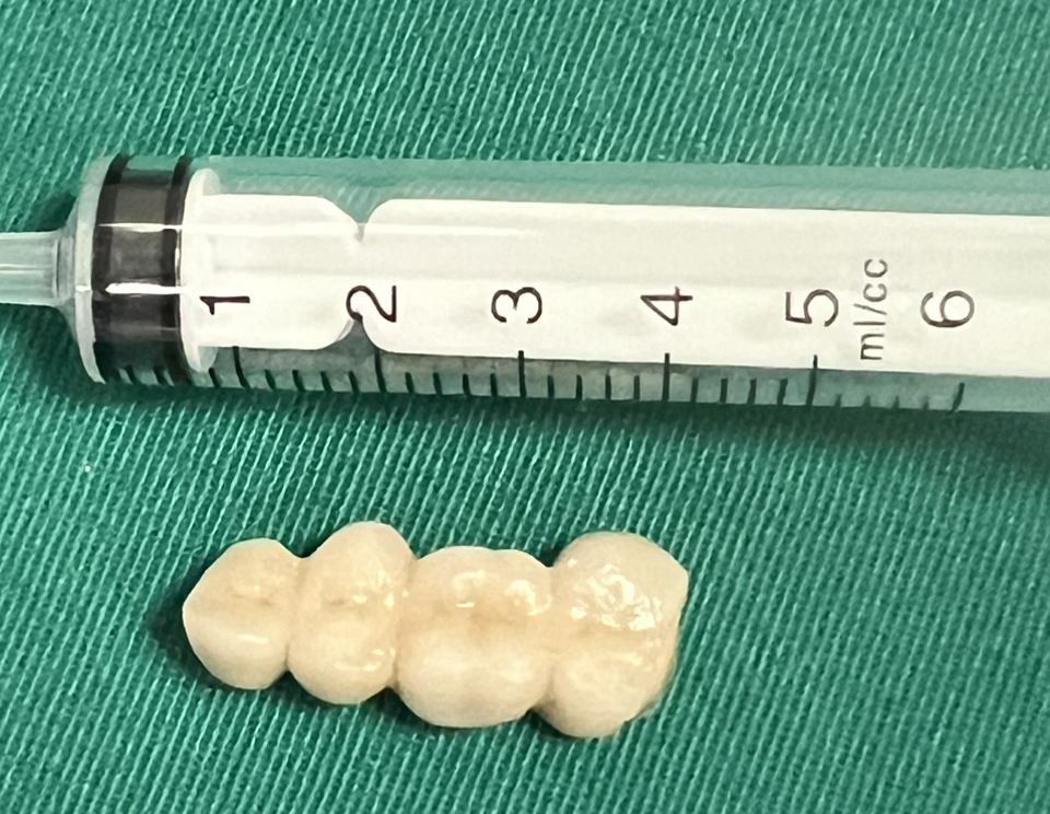 Răng giả của bệnh nh&acirc;n sau khi được lấy ra.