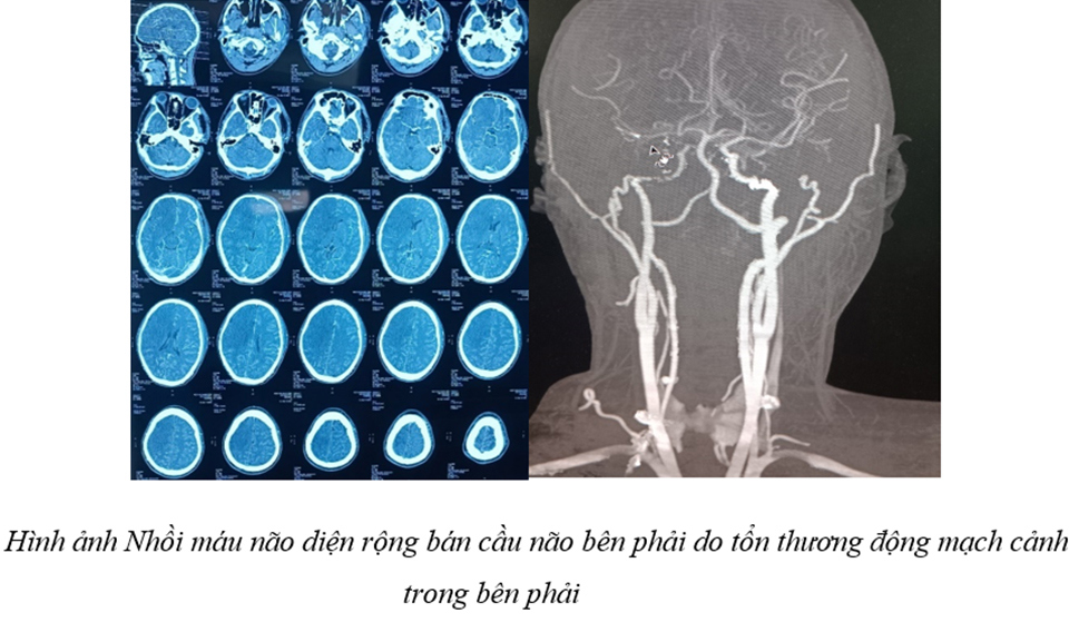 Không chủ quan với tổn thương mạch máu não sau chấn thương sọ não - Ảnh 1