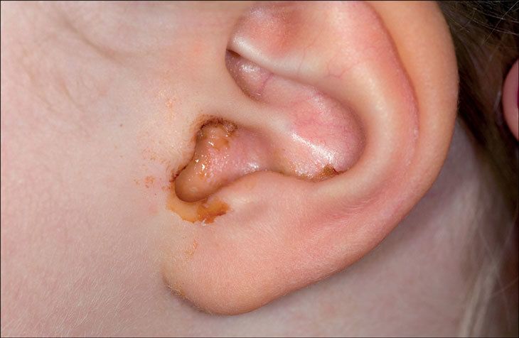 Cách vệ sinh tai cho trẻ bị viêm tai giữa - Ảnh 1
