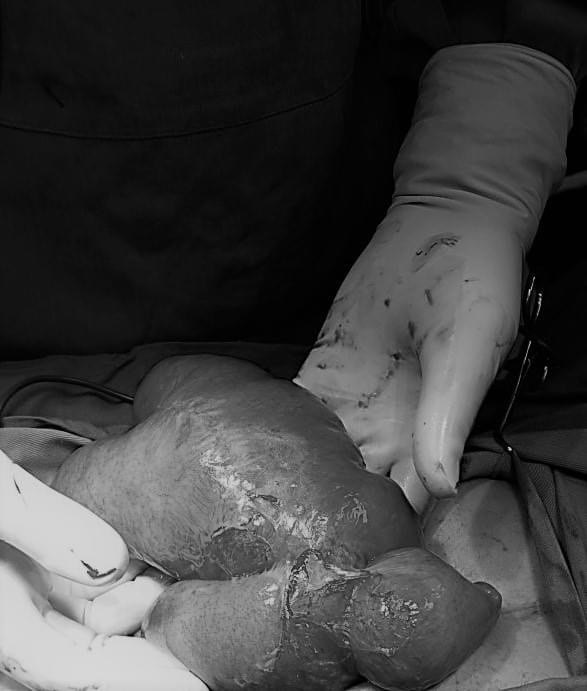 H&igrave;nh ảnh đoạn ruột bị tắc trong phẫu thuật