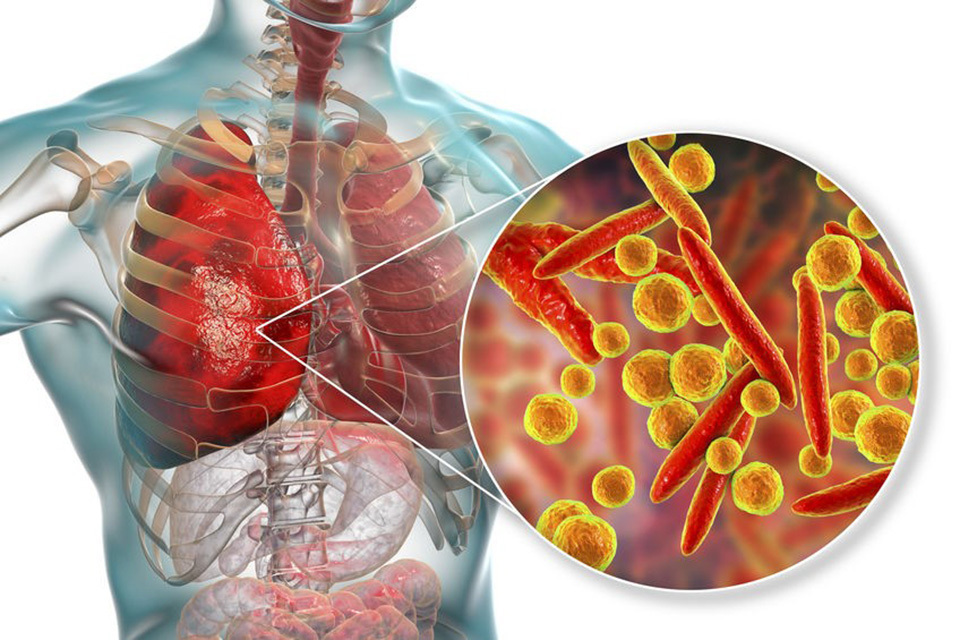 Vi&ecirc;m phổi do Mycoplasma g&acirc;y ra bởi vi khuẩn Mycoplasma pneumonia.