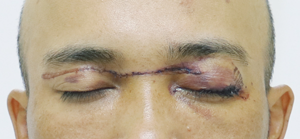 Anh P.T.V. (32 tuổi, ở Đ&ocirc;ng Triều, Quảng Ninh) bị d&acirc;y diều nằm vắt ngang đường, va v&agrave;o mắt khiến gần đứt rời m&iacute; tr&ecirc;n.