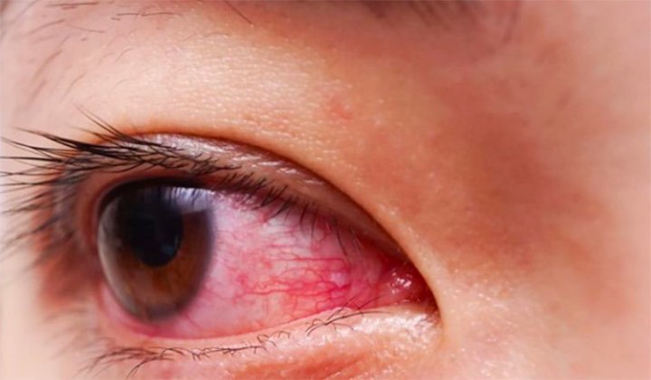 Một bệnh nhi bị đau mắt đỏ. Ảnh: Bệnh viện cung cấp