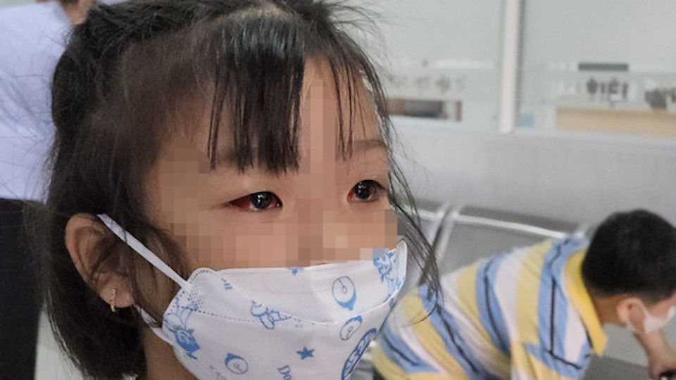 Trẻ đau mắt đỏ ở TP Hồ Ch&iacute; Minh gia tăng, nhiều ca biến chứng nặng đến vi&ecirc;m kết mạc c&oacute; giả mạc. Ảnh minh hoạ