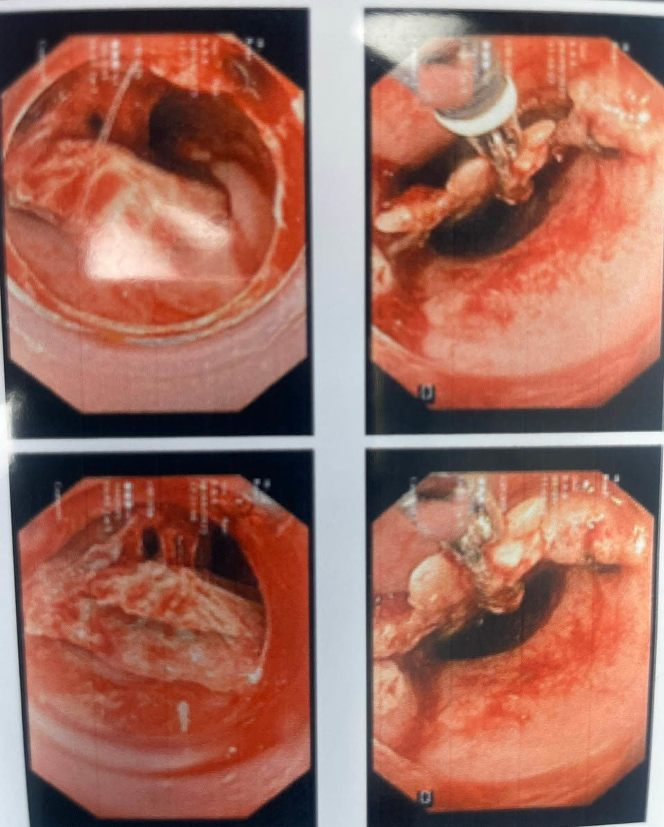 H&igrave;nh ảnh dị vật thực quản 1/3 tr&ecirc;n qua nội soi.