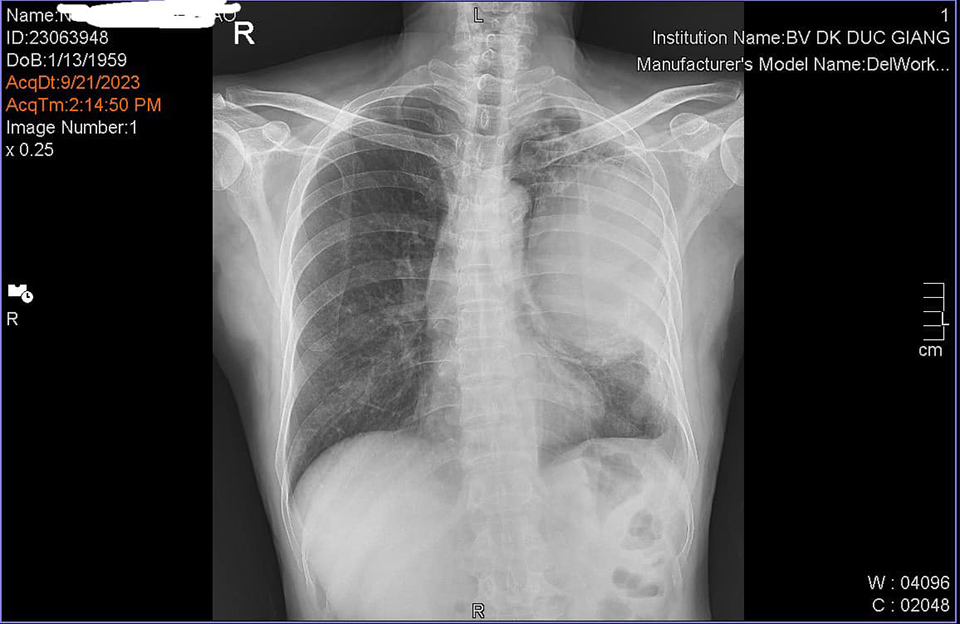 Kết quả chụp cắt lớp vi t&iacute;nh phổi, X-quang phổi cho thấy, khối u chiếm gần hết nhu m&ocirc; phổi b&ecirc;n tr&aacute;i.