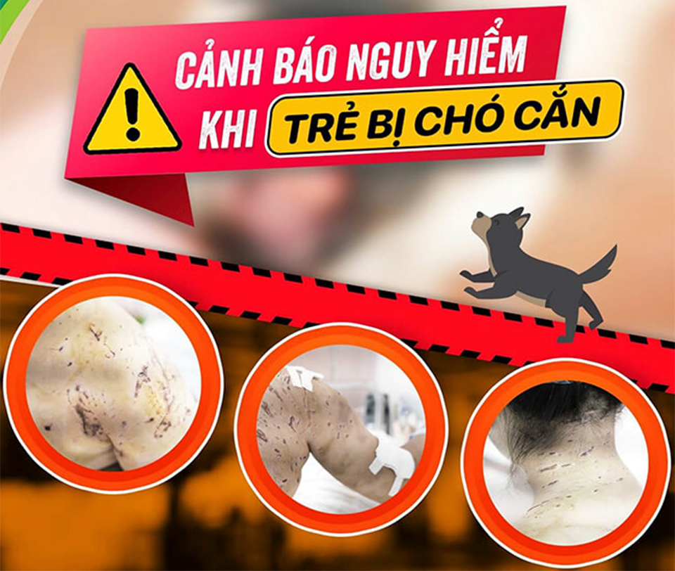 Cảnh b&aacute;o nguy hiểm khi trẻ bị ch&oacute; cắn