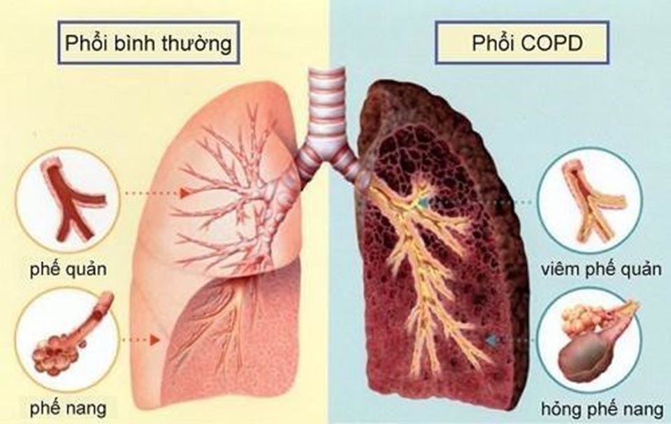 H&igrave;nh ảnh tổn thương phổi trong COPD