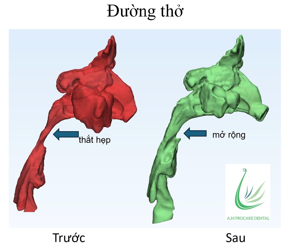 Thể t&iacute;ch đường thở được mở rộng nhiều sau phẫu thuật, ảnh trước sau