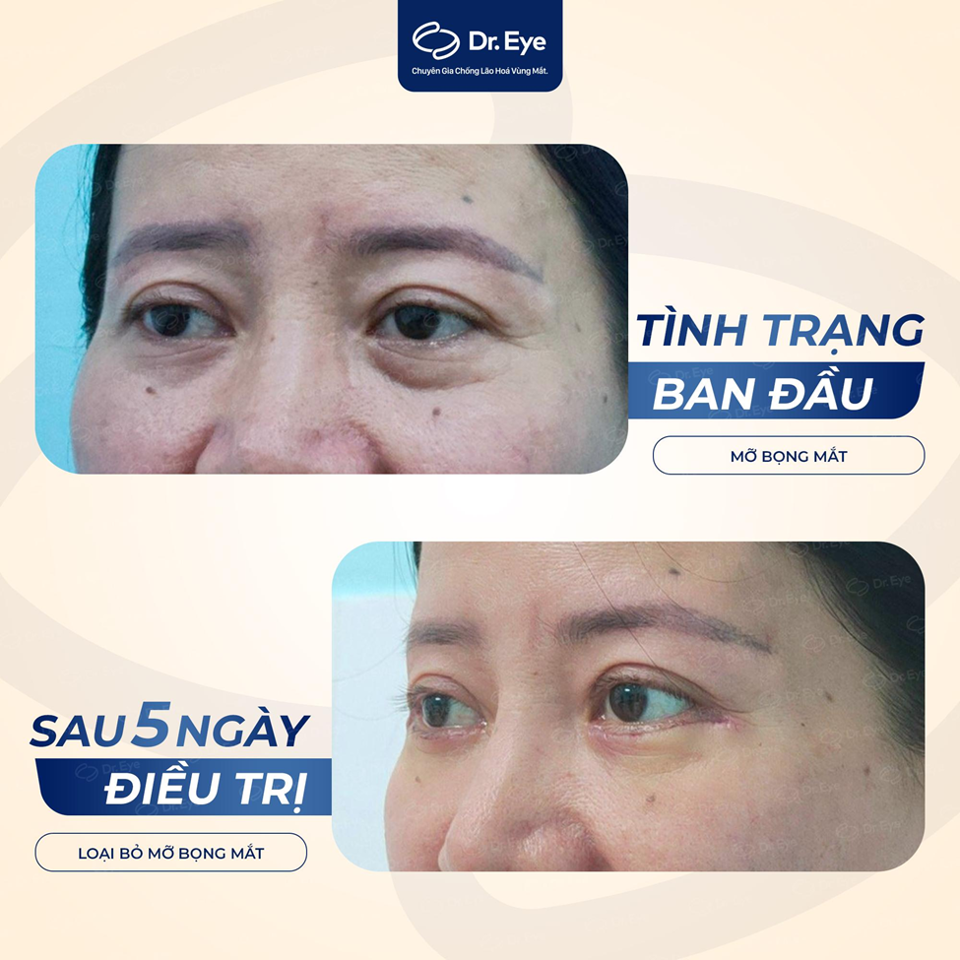 Tạm biệt đ&ocirc;i mắt gi&agrave; nua v&agrave; buồn rầu chỉ sau 5 ng&agrave;y điều trị bọng mắt tại Dr. Eye.