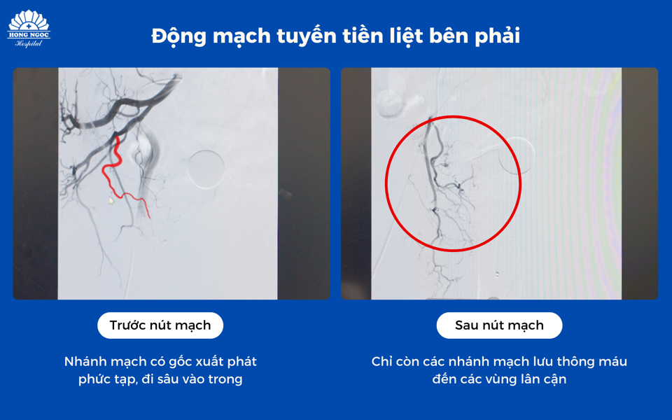 H&igrave;nh ảnh động mạch tuyến tiền liệt b&ecirc;n phải trước v&agrave; sau khi can thiệp.